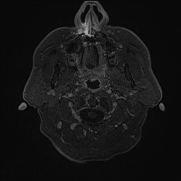 Cerebral arteriovenous malformation (Radiopaedia 84015-99245 Axial T1 C+ 4).jpg