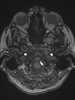 File:Cerebral arteriovenous malformation (Radiopaedia 84015-99245 Axial TOF 57).jpg