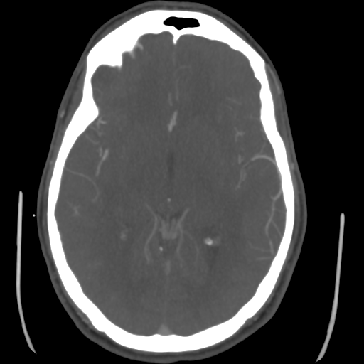 Cerebral arteriovenous malformation (Spetzler-Martin grade 2) (Radiopaedia 41262-44076 E 26).png