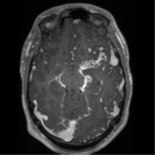 Cerebral arteriovenous malformation - huge (Radiopaedia 35734-37272 Axial T1 C+ 28).png