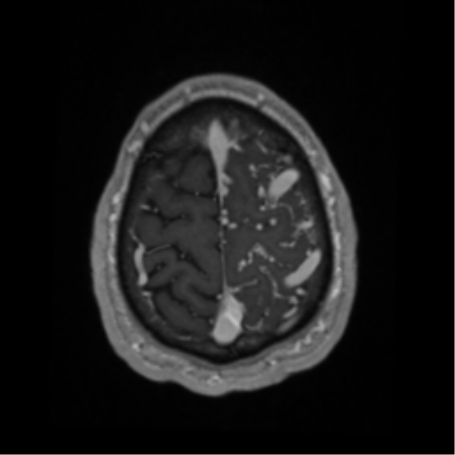 Cerebral arteriovenous malformation - huge (Radiopaedia 35734-37272 Axial T1 C+ 66).png
