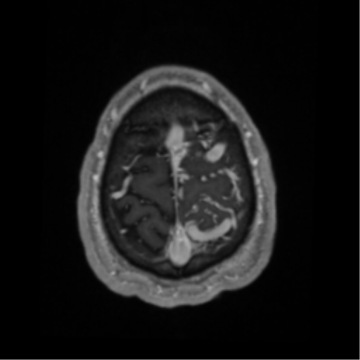 Cerebral arteriovenous malformation - huge (Radiopaedia 35734-37272 Axial T1 C+ 68).png