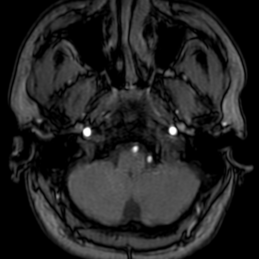 Cerebral arteriovenous malformation at posterior body of corpus callosum (Radiopaedia 74111-84925 Axial MRA 16).jpg