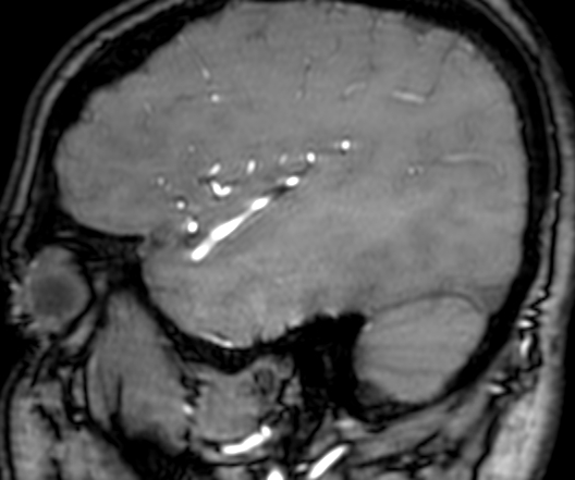 Cerebral arteriovenous malformation at posterior body of corpus callosum (Radiopaedia 74111-84925 J 323).jpg