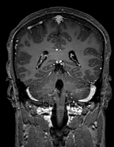 Cerebral arteriovenous malformation at posterior body of corpus callosum (Radiopaedia 74111-84925 K 245).jpg