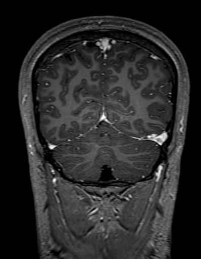 Cerebral arteriovenous malformation at posterior body of corpus callosum (Radiopaedia 74111-84925 K 299).jpg