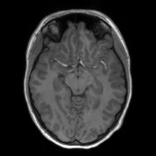 Cerebral cavernous venous malformation (Radiopaedia 70008-80021 Axial T1 30).jpg