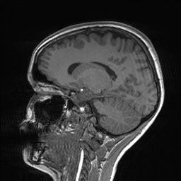 File:Cerebral cavernous venous malformation (Radiopaedia 70008-80021 Sagittal T1 30).jpg