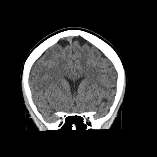 Cerebral cavernous venous malformation (Radiopaedia 70008-80022 non-contrast 27).jpg