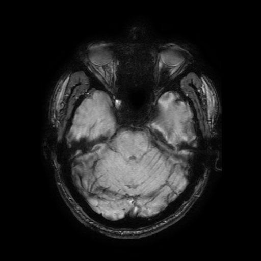 File:Cerebral cavernous venous malformation (Zabramski type II) (Radiopaedia 85511-101198 Axial SWI 46).jpg