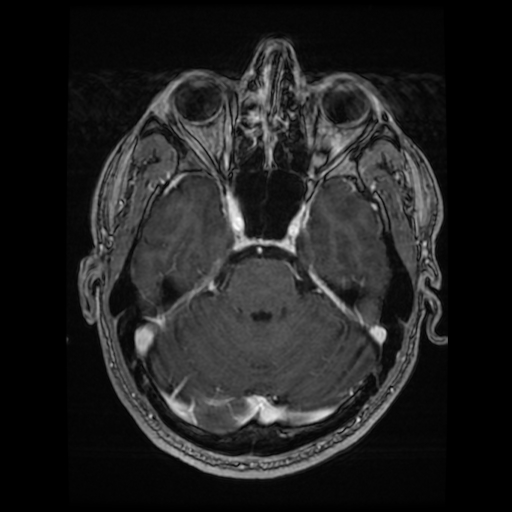 Cerebral cavernous venous malformation (Zabramski type II) (Radiopaedia 85511-101198 Axial T1 C+ fat sat 59).jpg