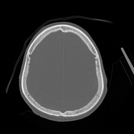 File:Cerebral contusions, subarachnoid hemorrhage and subdural hygromas (Radiopaedia 55399-61827 Axial bone window 40).png