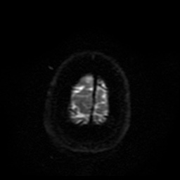 Cerebral embolic infarcts (embolic shower) (Radiopaedia 49837-55108 Axial DWI 3).jpg