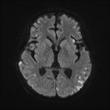 Cerebral embolic infarcts (embolic shower) (Radiopaedia 72391-82921 Axial DWI 45).jpg