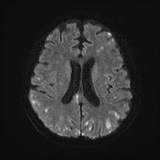 Cerebral embolic infarcts (embolic shower) (Radiopaedia 72391-82921 Axial DWI 48).jpg