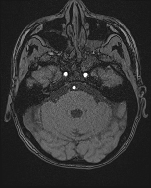 Cerebral embolic infarcts (embolic shower) (Radiopaedia 72391-82921 Axial MRA 31).jpg