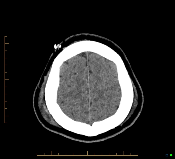 Cerebral fat embolism (Radiopaedia 85521-101224 Axial non-contrast 44).jpg