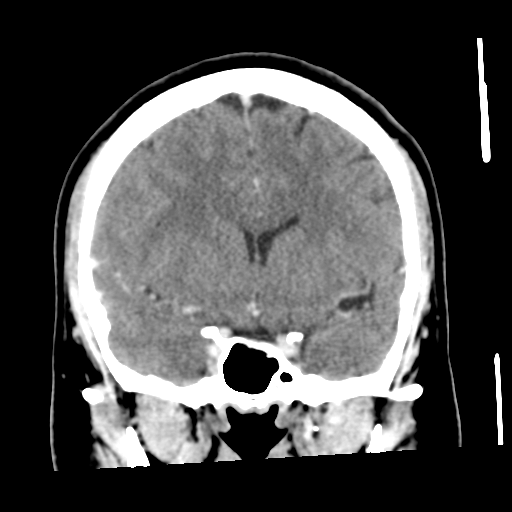 File:Cerebral hemorrhage secondary to arteriovenous malformation (Radiopaedia 33497-34561 C 27).png