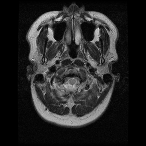 File:Cerebral hemorrhage secondary to arteriovenous malformation (Radiopaedia 33497-34572 Axial T2 2).png