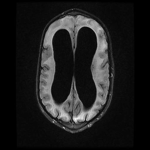 File:Cerebral manifestations of mucopolysaccharidosis type I (Radiopaedia 59171-66487 Axial FLAIR 14).jpg