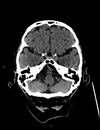 Cerebral metastases - ependymal and parenchymal (Radiopaedia 79877-93131 Axial non-contrast 13).jpg