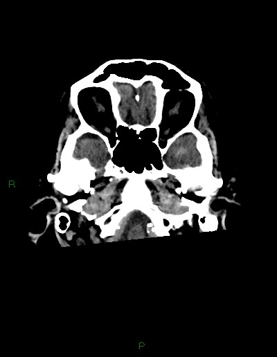 Cerebral metastases - ependymal and parenchymal (Radiopaedia 79877-93131 Axial non-contrast 4).jpg