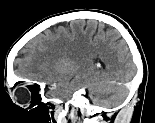 Cerebral metastases - testicular choriocarcinoma (Radiopaedia 84486-99855 F 39).jpg