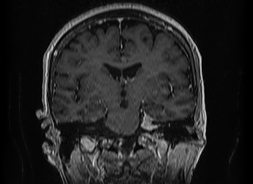 File:Cerebral metastases from lung cancer with amyloid angiopathy and cerebellopontine angle meningioma (Radiopaedia 74306-85191 Coronal T1 C+ 30).jpg