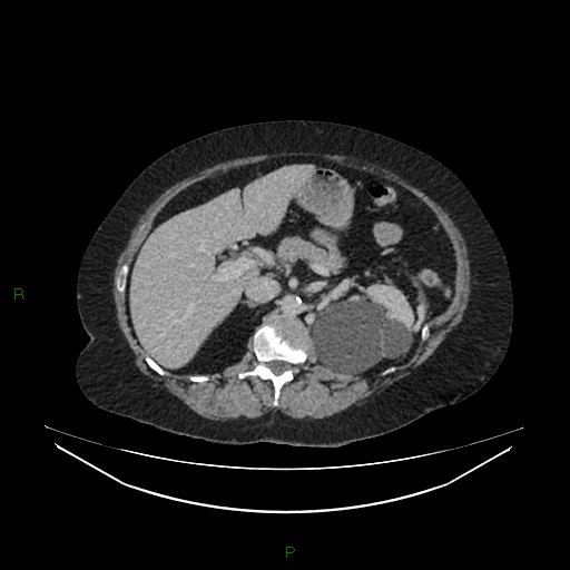 Cerebral metastasis from renal cell carcinoma (Radiopaedia 82306-96378 A 57).jpg