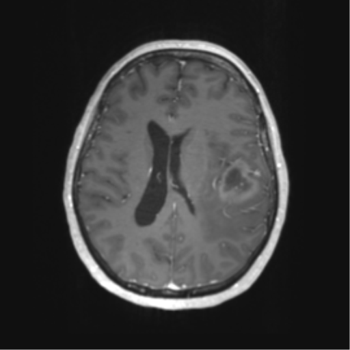 Cerebral metastasis mimicking glioblastoma (Radiopaedia 69155-78937 Axial T1 C+ 41).png