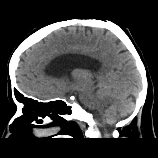 Cerebral metastasis to basal ganglia (Radiopaedia 81568-95412 E 35).png