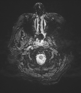 Cerebral metastasis to basal ganglia (Radiopaedia 81568-95413 Axial SWI magnitude 2).png
