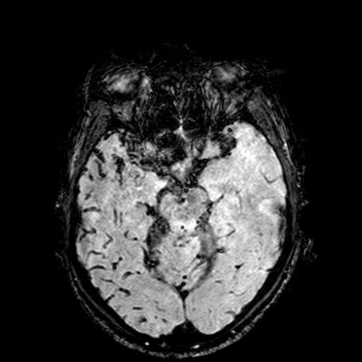 Cerebral parenchymal arteriovenous malformation (Radiopaedia 27280-27456 Axial SWI 38).jpg