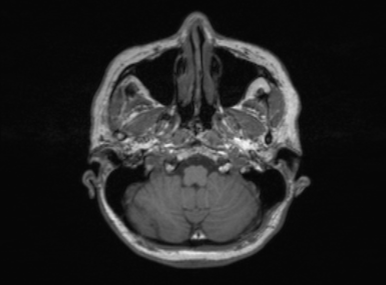 Cerebral ring enhancing lesions - cerebral metastases (Radiopaedia 44922-48817 Axial T1 329).jpg