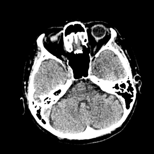 File:Cerebral ring enhancing lesions - cerebral metastases (Radiopaedia 44922-48818 Axial non-contrast 30).jpg