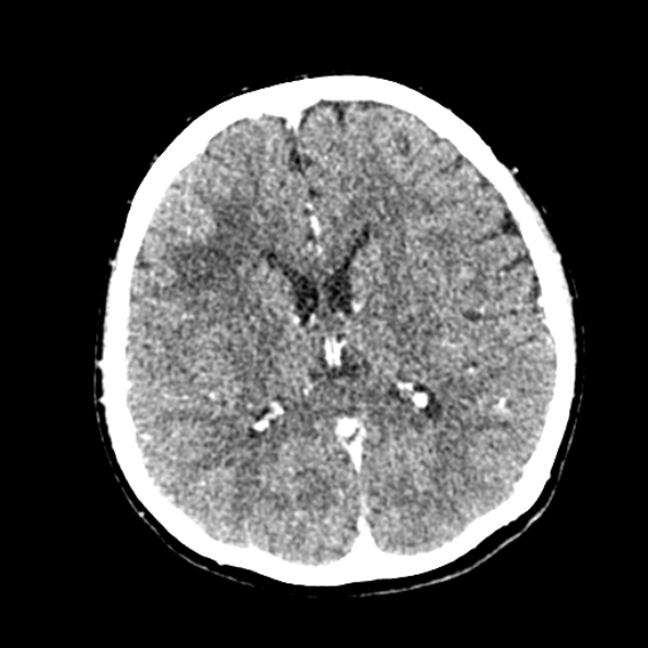 File:Cerebral ring enhancing lesions - cerebral metastases (Radiopaedia 44922-48818 B 165).jpg