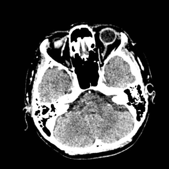 Cerebral ring enhancing lesions - cerebral metastases (Radiopaedia 44922-48818 B 79).jpg