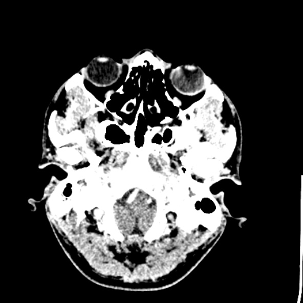 Cerebral toxoplasmosis (Radiopaedia 53993-60131 Axial C+ delayed 10).jpg