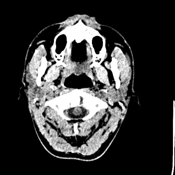 Cerebral toxoplasmosis (Radiopaedia 53993-60131 Axial non-contrast 2).jpg