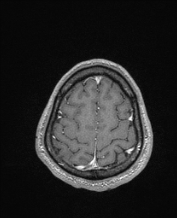 Cerebral toxoplasmosis (Radiopaedia 85779-101597 Axial T1 C+ 139).jpg