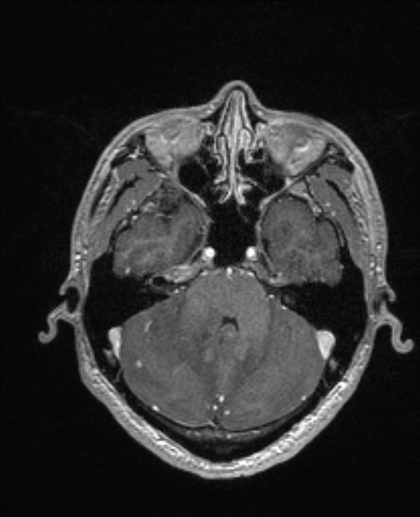 Cerebral toxoplasmosis (Radiopaedia 85779-101597 Axial T1 C+ 44).jpg
