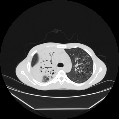 Cerebral tuberculoma (Radiopaedia 80829-94318 Axial lung window 56).jpg