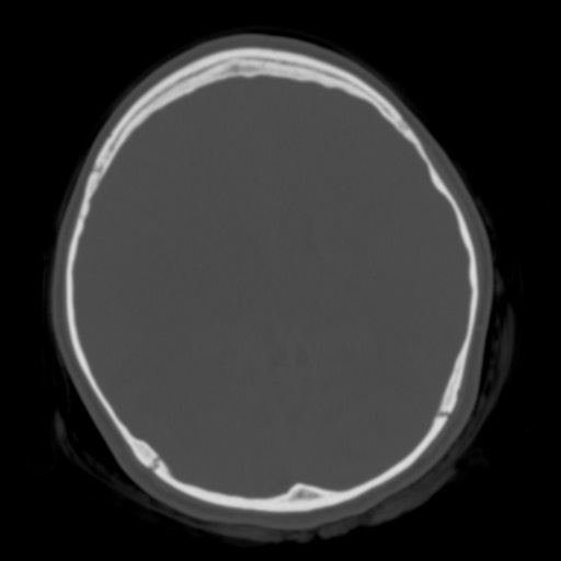 Cerebral tuberculosis with dural sinus invasion (Radiopaedia 60353-68018 Axial bone window 34).jpg