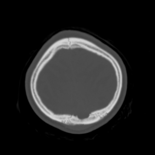 Cerebral tuberculosis with dural sinus invasion (Radiopaedia 60353-68018 Axial bone window 56).jpg