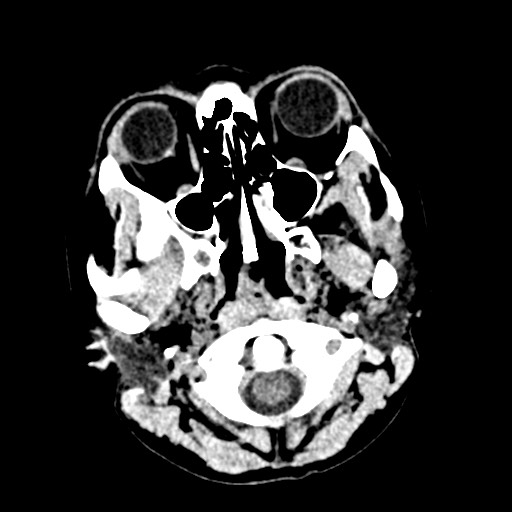 Cerebral tuberculosis with dural sinus invasion (Radiopaedia 60353-68018 Axial non-contrast 1).jpg