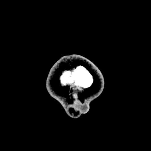 Cerebral tuberculosis with dural sinus invasion (Radiopaedia 60353-68018 Axial non-contrast 68).jpg
