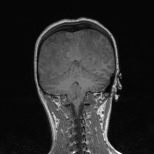 Cerebral tuberculosis with dural sinus invasion (Radiopaedia 60353-68090 Coronal T1 134).jpg