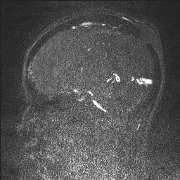 Cerebral tuberculosis with dural sinus invasion (Radiopaedia 60353-68090 Sagittal MRV 69).jpg