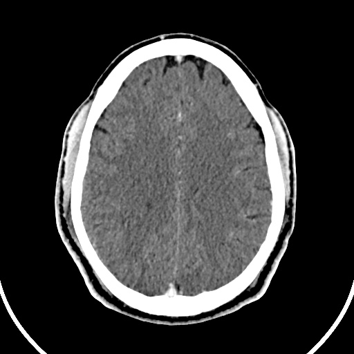 Cerebral venous angioma (Radiopaedia 69959-79977 B 67).jpg