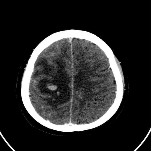 Cerebral venous hemorrhagic infarct from venous sinus thrombosis (Radiopaedia 55433-61883 Axial C+ delayed 39).jpg